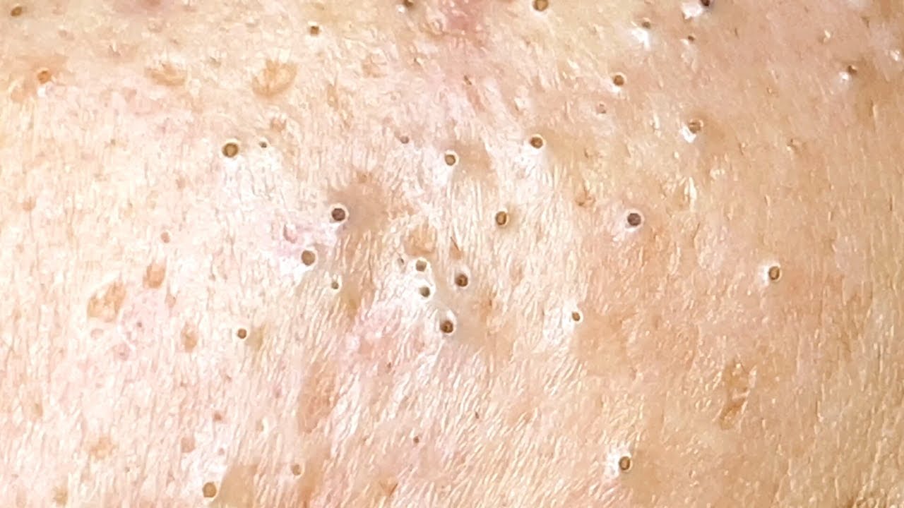 CTh is What Your Remove Blackheads Should Popping